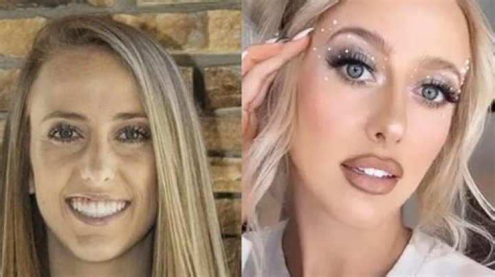 Brittany Mahomes’ Plastic Surgery: Did She Get Lip Fillers and Breast Implants?