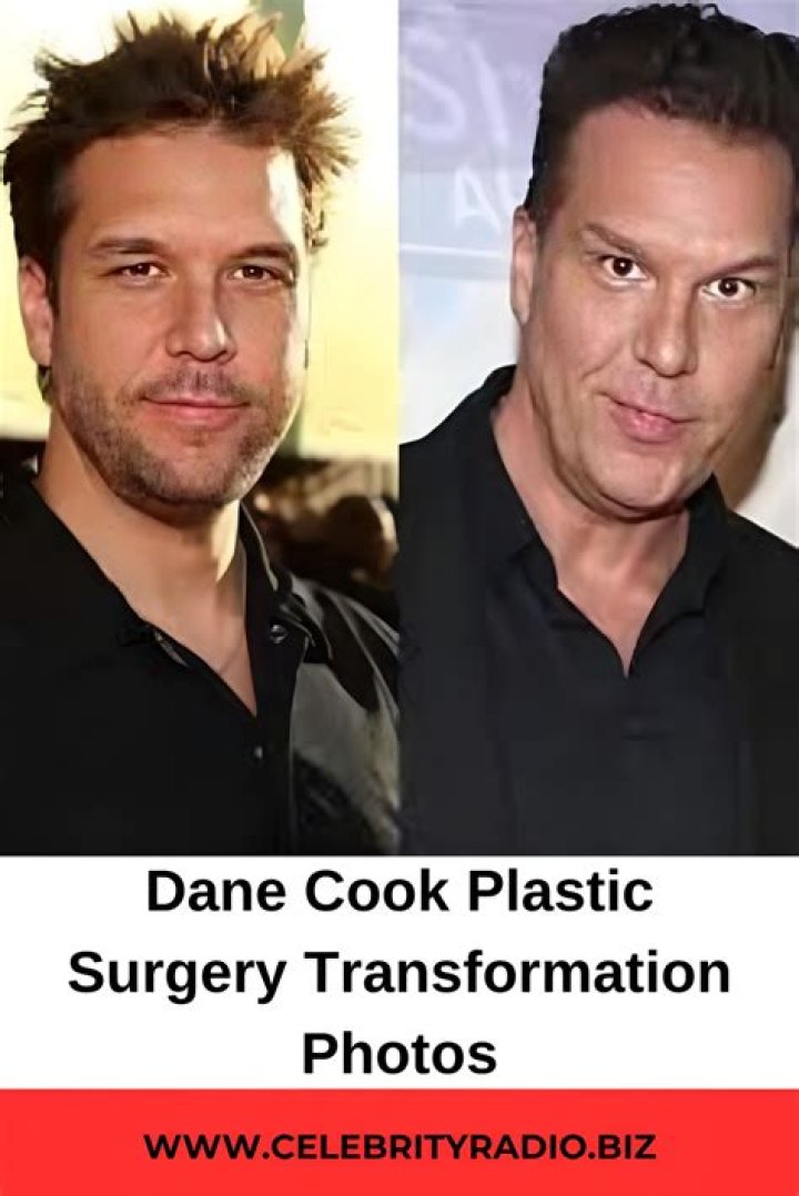 Dane Cook Plastic Surgery With Before And After Photos