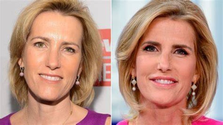 Did Laura Ingraham's Plastic Surgery Transform Her Appearance?