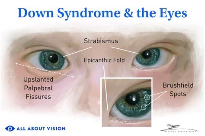 Exploring The Enigma Of Down Syndrome And Crew