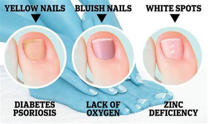What Do White Toes Mean